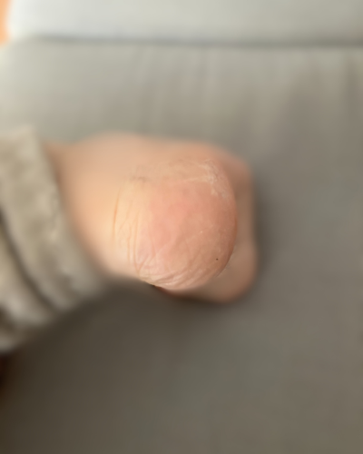 太陽ニットのかかとツルツル靴下（夜用）を一晩使用した後のかかと