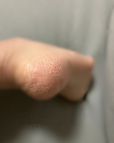 太陽ニットのかかとツルツル靴下（夜用）を使用する前のかかと